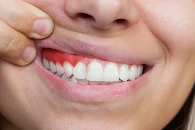 Rūkančio paciento dantenų pakitimų konsultacija pas periodontologę Vilniuje